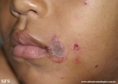 impetigo