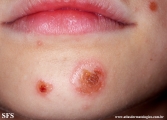 impetigo