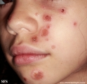 impetigo