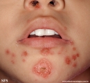 impetigo