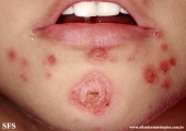 impetigo