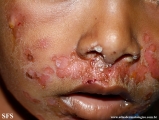 impetigo