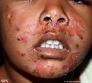 impetigo