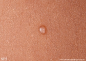 molluscum contagiosum