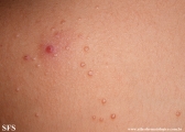 molluscum contagiosum