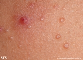 molluscum contagiosum