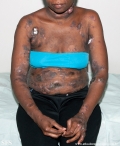 Cutaneous T-cell_lymphoma