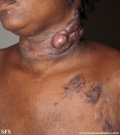 Cutaneous T-cell_lymphoma