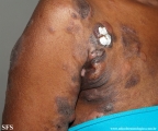 Cutaneous T-cell_lymphoma