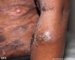 Cutaneous T-cell_lymphoma