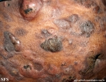 Cutaneous T-cell_lymphoma