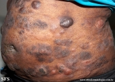 Cutaneous T-cell_lymphoma