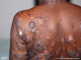 Cutaneous T-cell_lymphoma