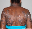 Cutaneous T-cell_lymphoma