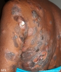 Cutaneous T-cell_lymphoma