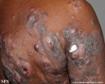 Cutaneous T-cell_lymphoma