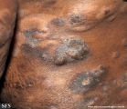 Cutaneous T-cell_lymphoma