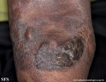 Cutaneous T-cell_lymphoma