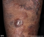 Cutaneous T-cell_lymphoma