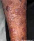 Cutaneous T-cell_lymphoma