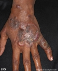 Cutaneous T-cell_lymphoma