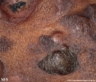 Cutaneous T-cell_lymphoma