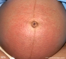 pruritic urticarial papules and plaques of pregnancy