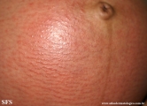 pruritic urticarial papules and plaques of pregnancy