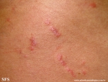 pruritic urticarial papules and plaques of pregnancy