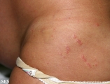 pruritic urticarial papules and plaques of pregnancy