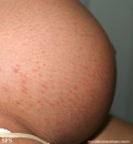 pruritic urticarial papules and plaques of pregnancy