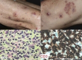 Cutaneous T-cell_lymphoma