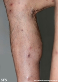 Cutaneous T-cell_lymphoma