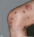 Cutaneous T-cell_lymphoma