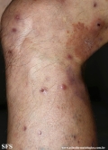 Cutaneous T-cell_lymphoma