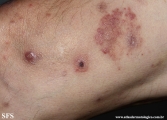 Cutaneous T-cell_lymphoma