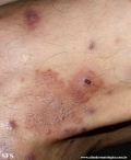 Cutaneous T-cell_lymphoma