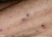 Cutaneous T-cell_lymphoma