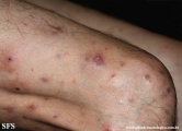 Cutaneous T-cell_lymphoma