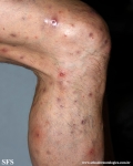 Cutaneous T-cell_lymphoma