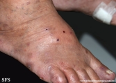 Cutaneous T-cell_lymphoma