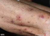 Cutaneous T-cell_lymphoma