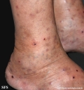 Cutaneous T-cell_lymphoma