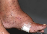 Cutaneous T-cell_lymphoma