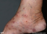 Cutaneous T-cell_lymphoma