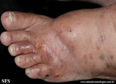 Cutaneous T-cell_lymphoma