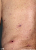 Cutaneous T-cell_lymphoma