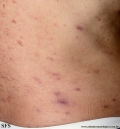 Cutaneous T-cell_lymphoma