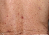 Cutaneous T-cell_lymphoma