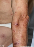 Cutaneous T-cell_lymphoma